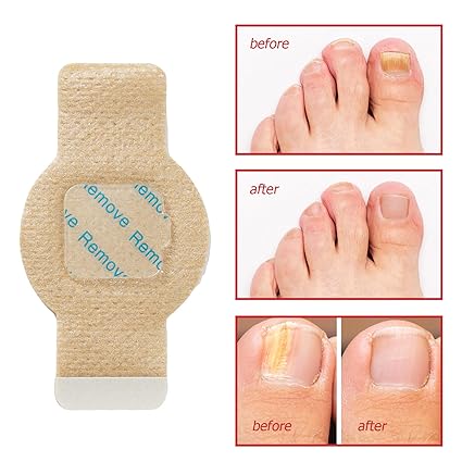 21 PCS Antifungal Nail Treatment Patches | Advanced Nail Repair for Damaged, Cracked & Discolored Nails - The Huntx Finds